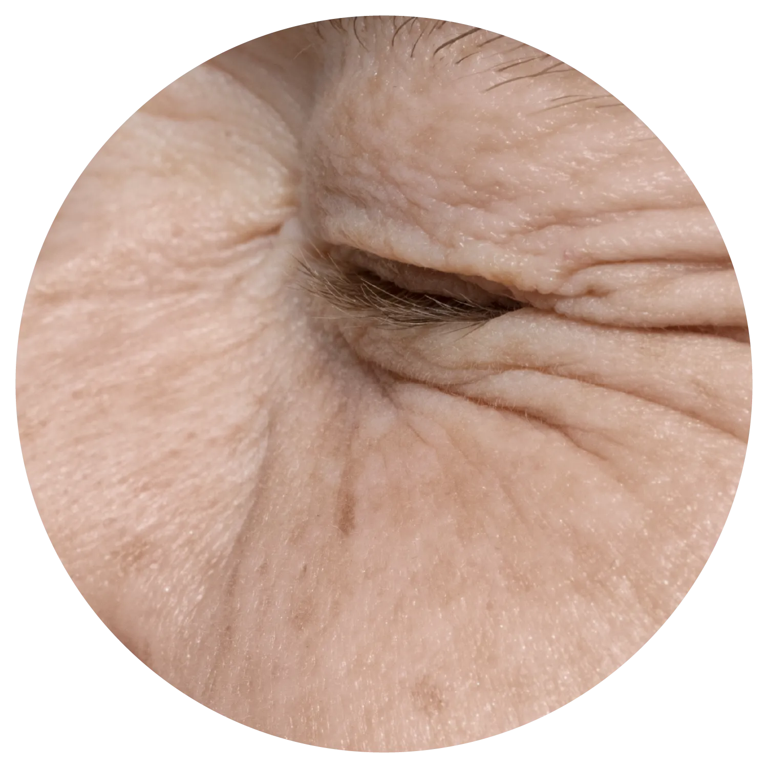 Periorbital Wrinkles treatment process at Toronto medical spa - Understand the root of the lines—beyond the surface.